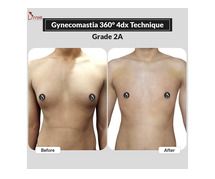 Gynecomastia Surgery in India with Best Plastic Surgeon