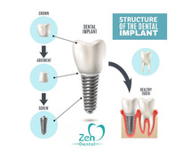 Best Dental Implants Treatment in Sarjapur Road, Bangalore