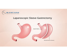 Best Laparoscopic Sleeve Gastrectomy Treatment in Bangalore