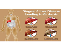 Best Liver Cirrhosis Treatment in India - MedTravellers