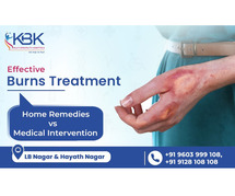 Light Burns: Quick Treatment Options | KBK Hospitals