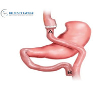 Best Laparoscopic Banded Gastric Bypass Treatment in Bangalore