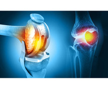 Total Knee Replacement Surgery in Nagpur - Gadge Hospital