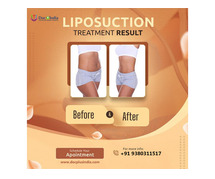 Expert Liposuction Surgery in Hyderabad at Docplus India