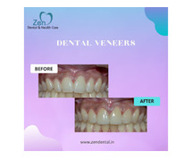 Best Veneers/Laminates Treatment in Sarjapur Road, Bangalore