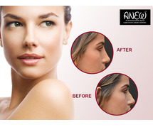 Refine Your Look with Non-Surgical Rhinoplasty in Bangalore