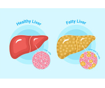 Fairpharma's Ayurvedic Medicine for Fatty Liver: A Natural Solution