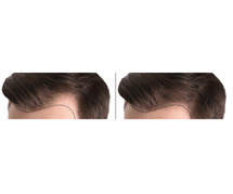 Best Hair Transplant in Mumbai