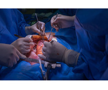 Heart Transplant Doctor in Delhi