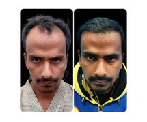 Long Hair Transplant in India - Dr. Amit Gupta