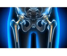 Total Hip Replacement In Nagpur - Gadge Hospital