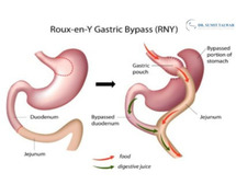 Best Laparoscopic RnY Gastric Bypass Treatment in Bangalore