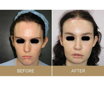 Facial Feminization Surgery Cost in USA