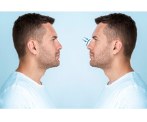 Top Nose Plastic Surgery with Naksh Rhinoplasty Expert Results