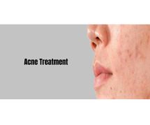 Acne Treatment in Bangalore