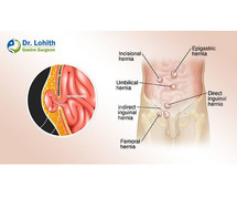 Get the Best Hernia Surgery in Bangalore