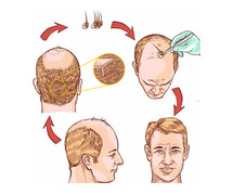 Hair Transplant treatment in Chennai