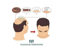 FUT Hair Transplant in Mumbai