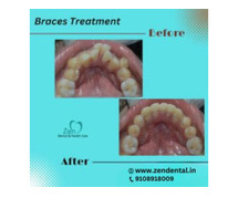 Best Dental Braces Treatment in Bangalore - Zen Dental Care