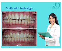 Best Invisalign Doctor in Sarjapur Road, Bangalore