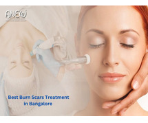 Best Burn Scars Treatment in Bangalore - Anew Cosmetic Clinic