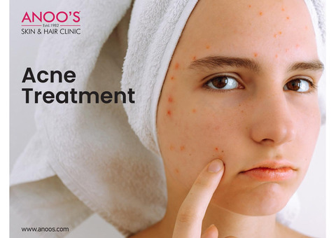 Advanced Acne removal treatment in Hyderabad