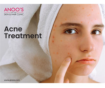 Advanced Acne removal treatment in Hyderabad