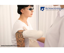 Top Tattoo Removal Clinic in Delhi - Effective Laser Tattoo Removal at Kosmoderma