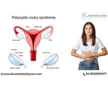 Best PCOS Treatment in Bangalore - Dr. Sumit Talwar