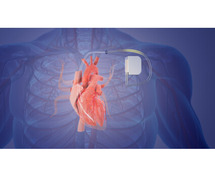 Pacemaker Surgery in Saket