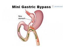 Best Laparoscopic Mini Gastric Bypass Treatment in Bangalore