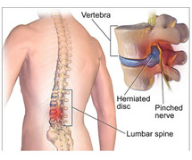 Understanding Spine Surgery Cost in India with Care Assist Wellness