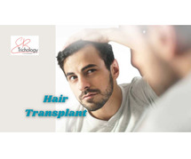 Hair Transplant in Gurgaon - SB Trichology