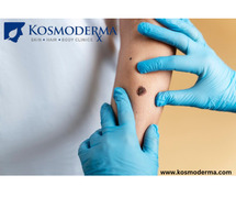 Kosmoderma: Expert Wart and Mole Removal Services in Bangalore