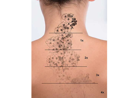 Radiance clinic for Tatoo Removal