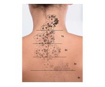 Radiance clinic for Tatoo Removal