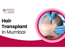 Hair Transplant in Mumbai