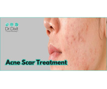 Acne Treatment in Bangalore | Lowest Cost Estimate