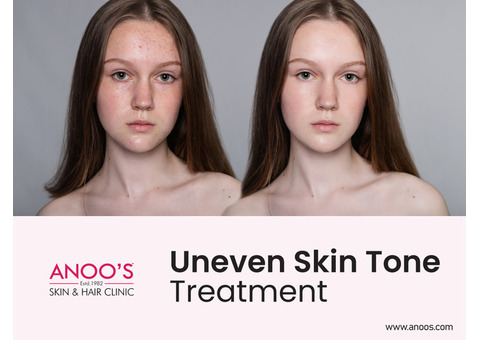 Advanced Uneven skin tone treatment at ANOOS