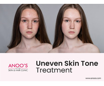 Advanced Uneven skin tone treatment at ANOOS