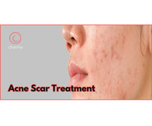 Acne Scar Treatment in Bangalore | Lowest Cost Estimate