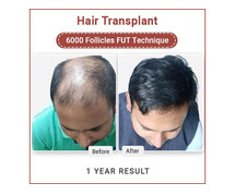 Best Hair Transplant And Hair Loss Treatment In Delhi