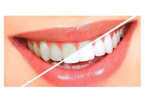 Best Teeth Whitening in Bangalore | teeth whitening cost in Bangalore