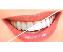 Best Teeth Whitening in Bangalore | teeth whitening cost in Bangalore