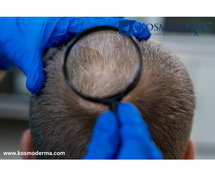 Kosmoderma: Expert Scalp Scar Removal Treatments in Delhi