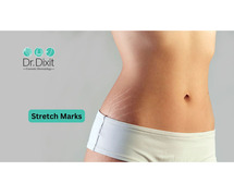 Stretch Marks Treatment in Bangalore