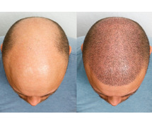 Hair Transplant treatment in Chennai