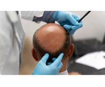 Free Natural looking Hair Transplant in Delhi