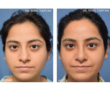 Expert Rhinoplasty Surgery for a Natural Looking Nose