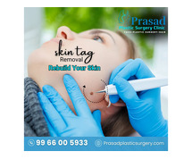 Skin Tag Removal Treatment in Visakhapatnam